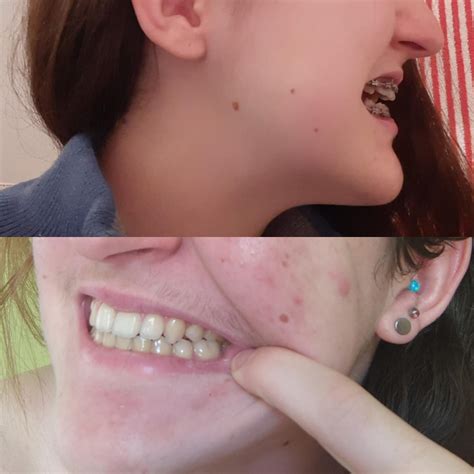 Long-term results (~2.5 years post-op) open bite, surgery by Dr. Köhnke
