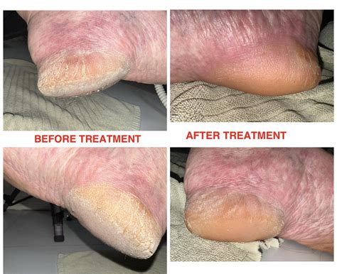 The Podology - 📍CRACKED HEELSTREATMENT : การรักษาอาการส้นเท้าแตก 📍HARD