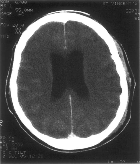 Case 1. Acute postoperative obstructive hydrocephalus with ventricular ...