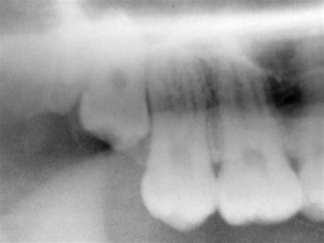 molar impaction surgery  september