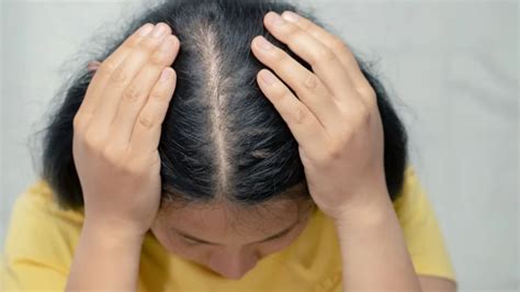 How To Stop Hair Loss From Ozempic