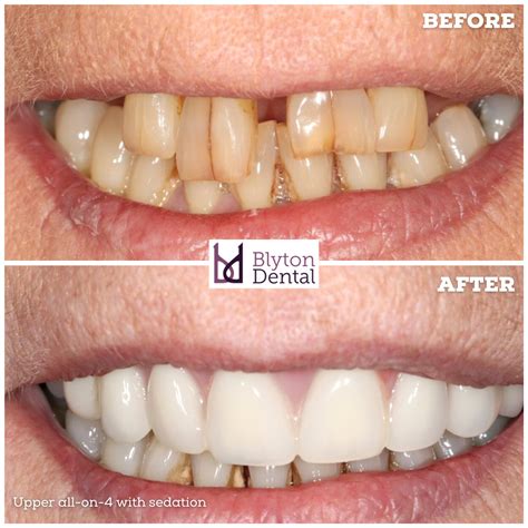Upper all-on-4 with sedation — Blyton Dental