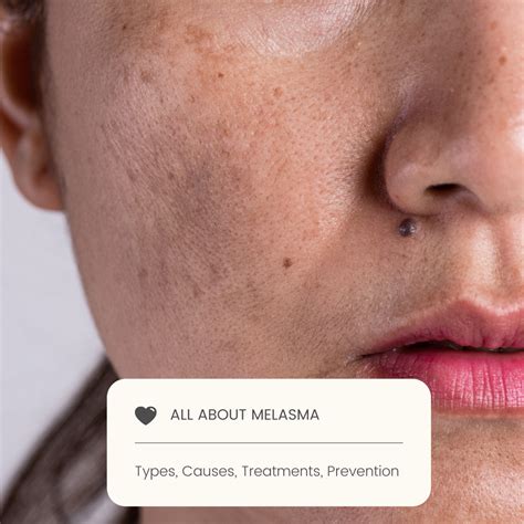melasma treatments types prevention