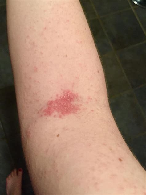 kind  rash     askdocs