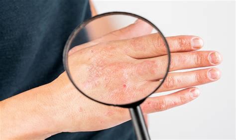 understanding eczema symptoms  prevention  treatment