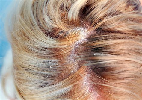 Why Do I Have Dry Patches of Skin on the Face and Body? — Moody Sisters