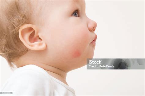 Bebe Com Bochecha Vermelha - Foto de Erupção Vermelha Na Bochecha Infantil Bebê Isolado No Fundo ...