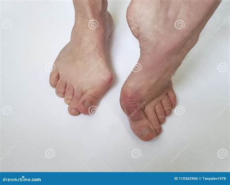 Hallux Valgus Female Leg Orthopedic Deformity Painful On A White ...