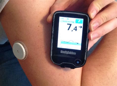 Automated Insulin Delivery Systems | Encyclopedia MDPI