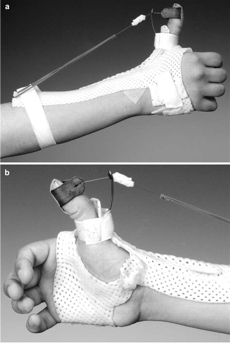 Evaluation of Early Dynamic Splinting versus Static Splinting for