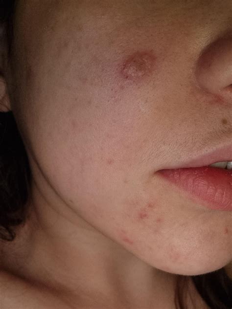 What is this bump in my cheek? : r/DermatologyQuestions