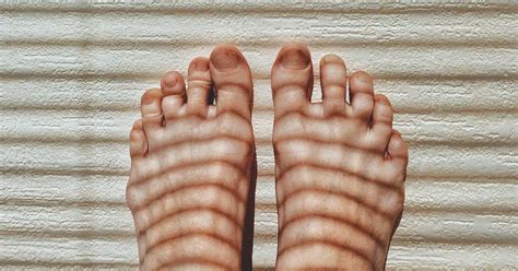 Red Toes: Symptoms, Causes, and Treatments