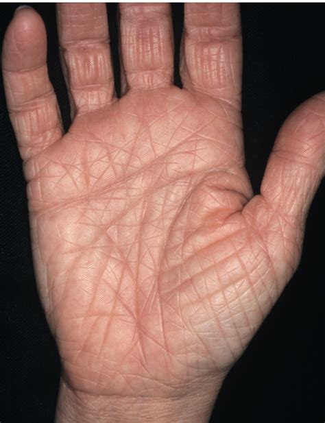 Atopic Dermatitis Palms