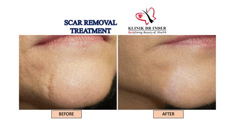Cool Do Tattoo Removal Scars Heal Ideas - clowncoloringpages