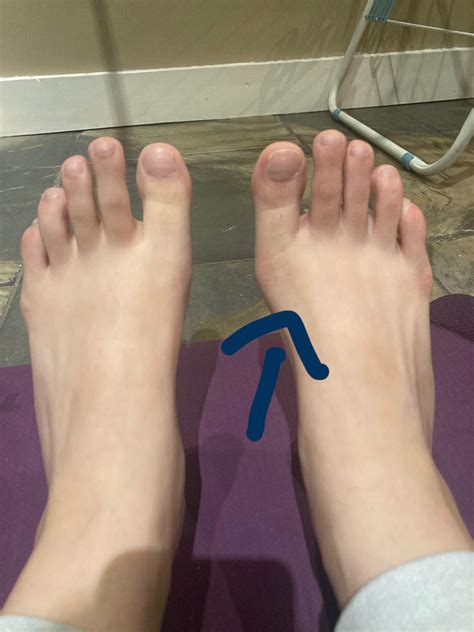 Baby bunion. Reversible?! : r/bunions