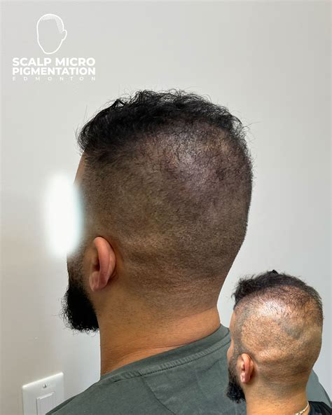 Transformative Solutions for Hair Transplant Scar Patients - SMP