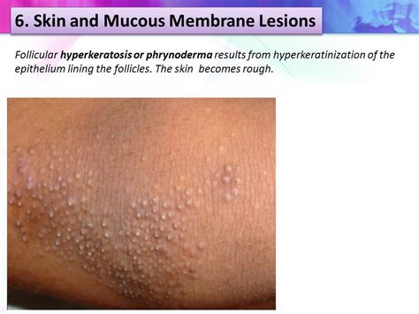 Follicular Hyperkeratosis Vitamin A Deficiency