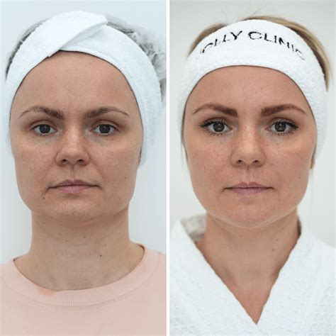 RF-лифтинг Morpheus8 от 40000 руб - Jolly Clinic