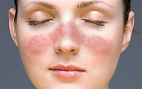 Lupus – bolest za sva vremena – Prof. Stefanović