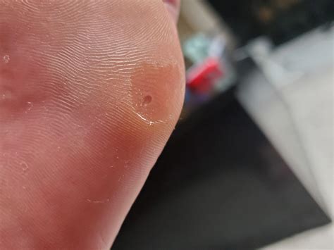 Blocked Sweat Gland On Bottom Of Foot Deals | emergencydentistry.com