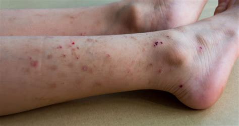 darah kotor  badan adalynknoegeorge