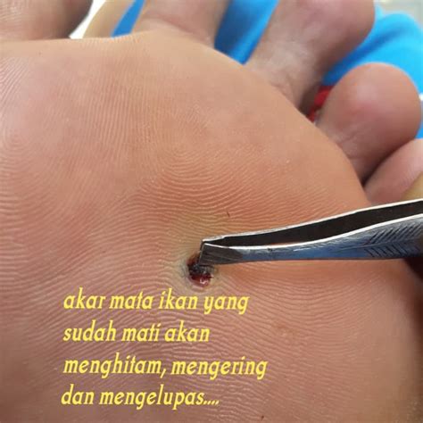 Jual Obat penyakit mata ikan atau clavus bukan plester salep callusol ...