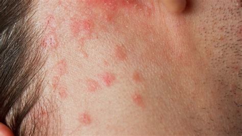 Itchy Rash On Neck Allergic Reaction at Kecia Martin blog