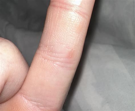 A single new burrow a month after treatments : r/scabies