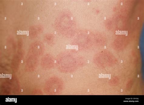 Lupus skin disease hi-res stock photography and images - Alamy