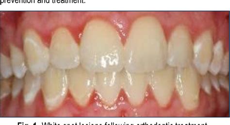 Figure 1 from WHITE SPOTS ON TEETH OR BLACK MARKS ON TREATMENT RESULTS ...