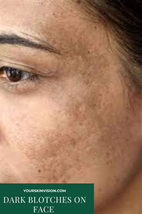 Dark Blotches On Face: Causes, Treatments, And Remedies