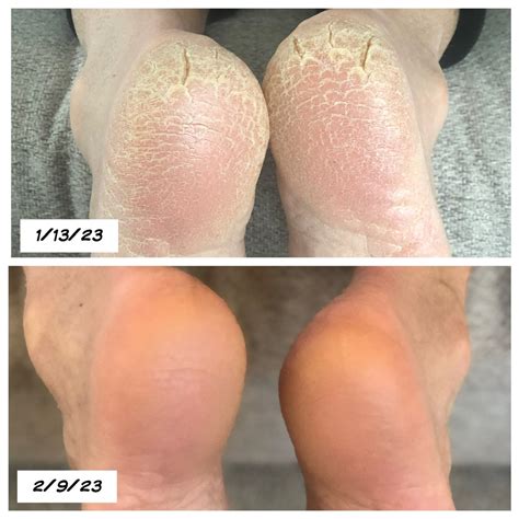 Heel Balm Testimonials – Tropical Tallow