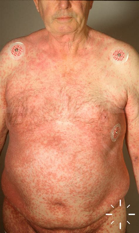 Types Of Stevens Johnson Syndrome at Jean Begaye blog