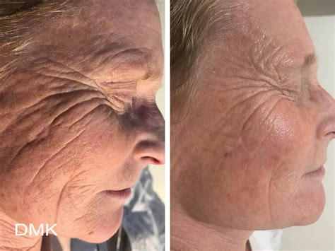 Anti age behandling | Låt oss behandla de oönskade rynkorna