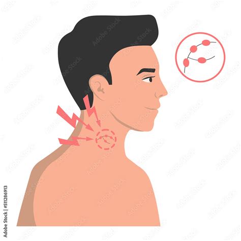 swollen lymph nodes   symptom   virus flu colds vector