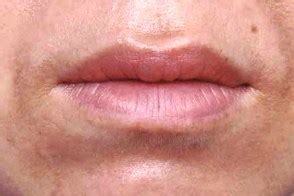 Меланозы лица (facial melanoses)