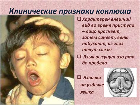 Сестринская помощь при скарлатине и коклюше - презентация онлайн