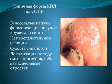 Псориаз. Красный плоский лишай - презентация онлайн