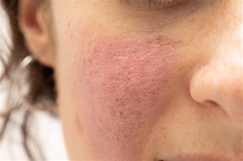 Our Editor's Top Picks For Rosacea-Prone Skin