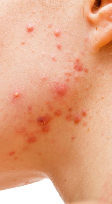 Dermatologia general I Acne | Inederm