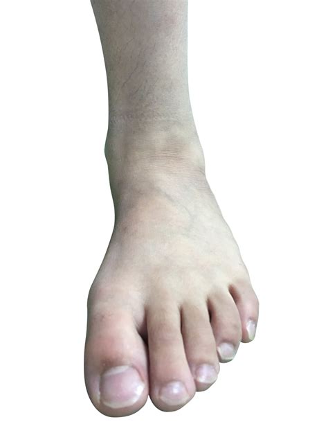 Ankle alignment causing flat feet | Dubai Podiatry Centre