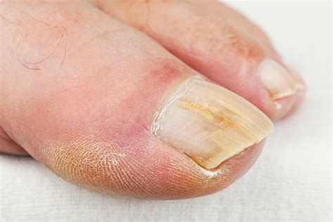 630+ Manchas Blancas En Las Uñas De Los Pies Fotografías de stock ...