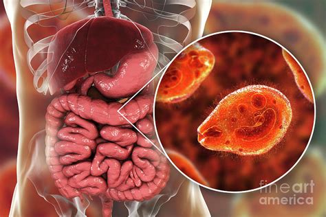 Balantidiasis Photograph by Kateryna Kon/science Photo Library - Pixels