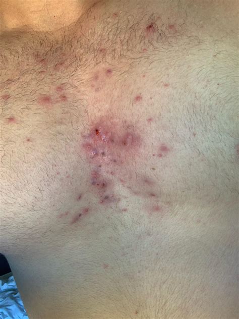 Chest Acne Gym at Marjorie Lockett blog