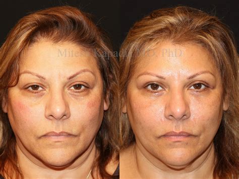 Before and three months after bilateral upper blepharoplasty with right ...