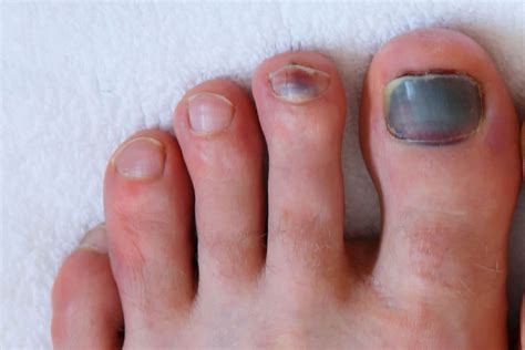 THE PODIATRY - Subungual haematomas (Bleeding under nail)