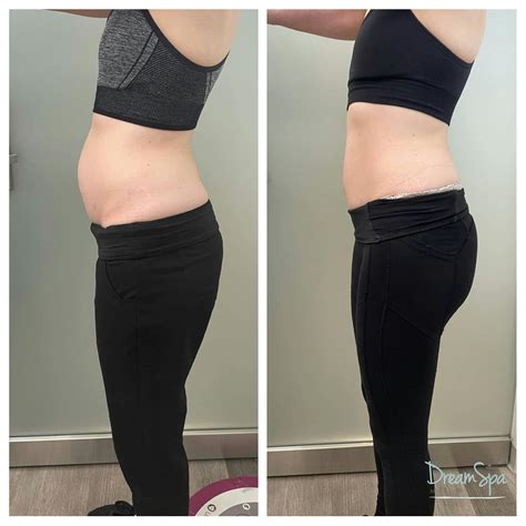 Body Contouring Before & After Photos | Dream Spa Medical