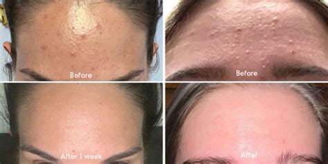 Fungal Acne Before and After – Almond Clear