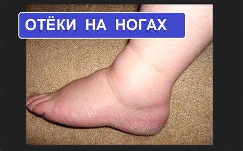 Отеки ног, причины и лечение у пожилых людей, отеки ног у пожилых