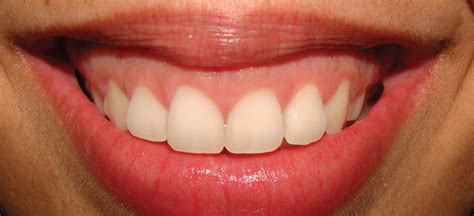 short teeth dr amarnathan dental clinic